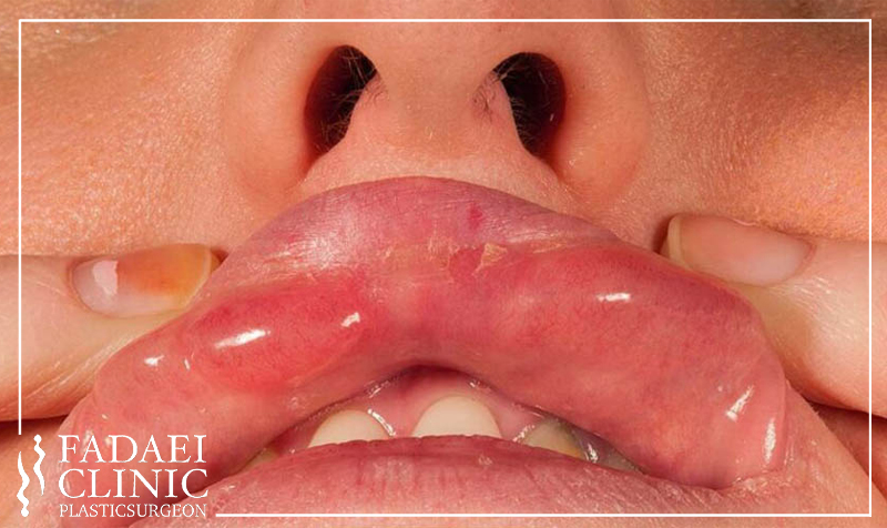 تخلیه ژل لب