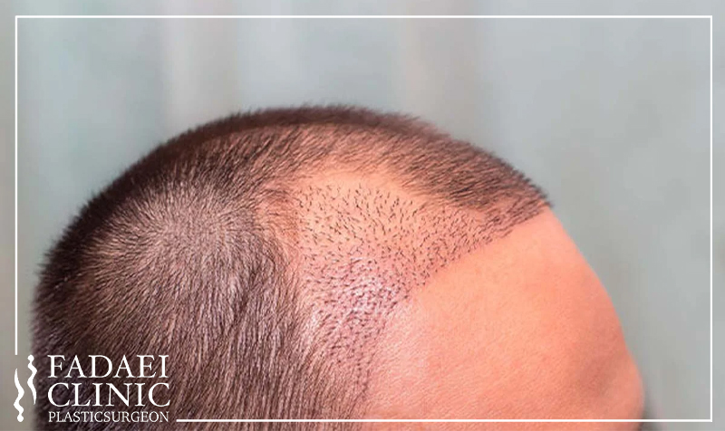 ریزش مو بعد از کاشت