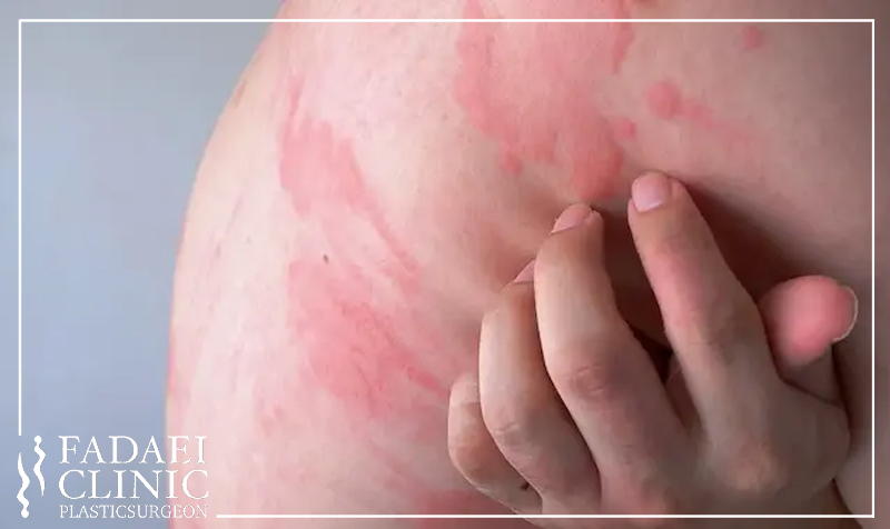 سوختگی لیزر