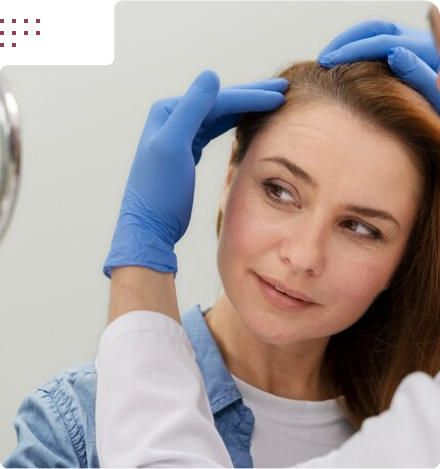 مزایای کاشت مو