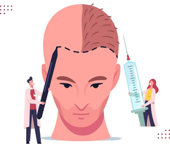 مراحل کاشت مو